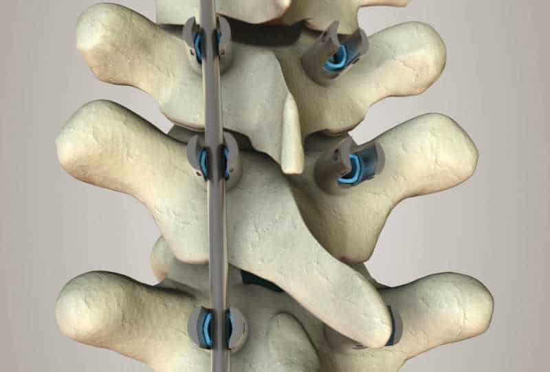 3D medtronic solera 02
